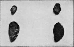 Great hypertrophy of thyroid and parathyroid glands after prolonged feeding on raw meat.