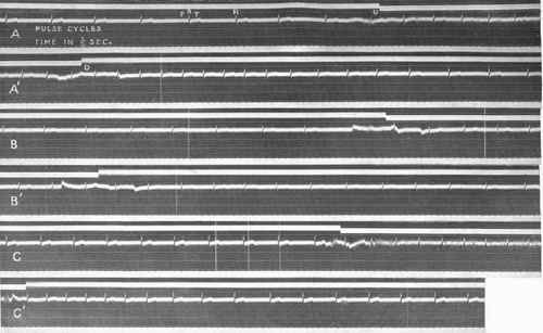 Sample pulse records showing changes in the pulse rate occasioned by short periods of exertion.