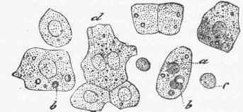 Liver cell of man, containing fat globules (b) and biliary matters.