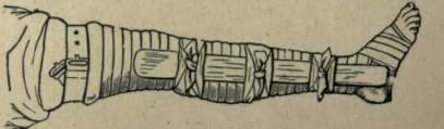BANDAGE AND SPLINT ON LEG
