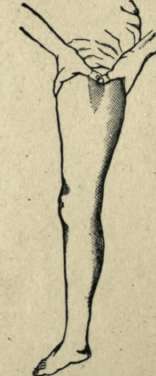 PRESSURE ON ARTERY OF THIGH