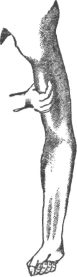 Pressure On Artery Of Arm
