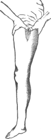 Pressure On Artery Of Thigh