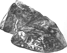 Tuberculous Lung