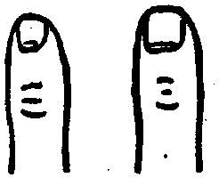 Short Square Nails. Weak Action Of The Heart.