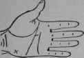 Intestinal Abscess 179