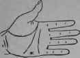 Laryngitis 155