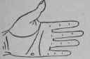 Laryngitis 157