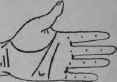 Laryngitis 166