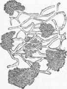 Pityriasis versicolor.