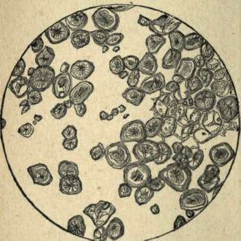 CORNSTARCH CORPUSCLES Seen under the Microscope