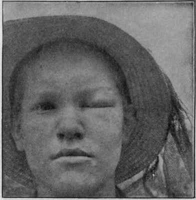 The Result of a Bee's Sting